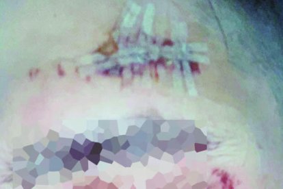 L'agressió li va provocar una ferida oberta a la cara.