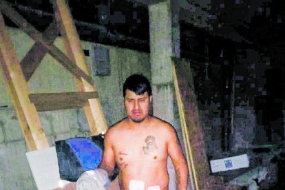 L'home amb el tors nu i les gases protegint les cicatrius.