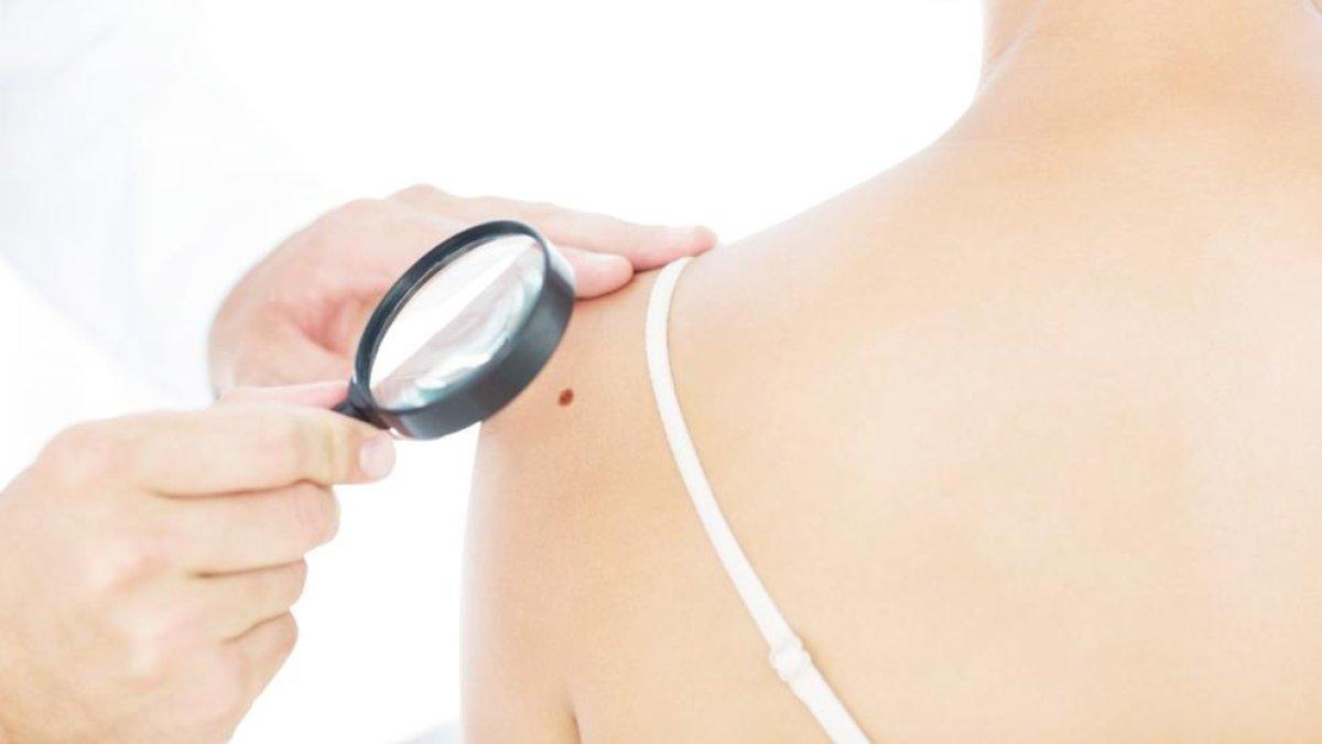 Prevenció del melanoma