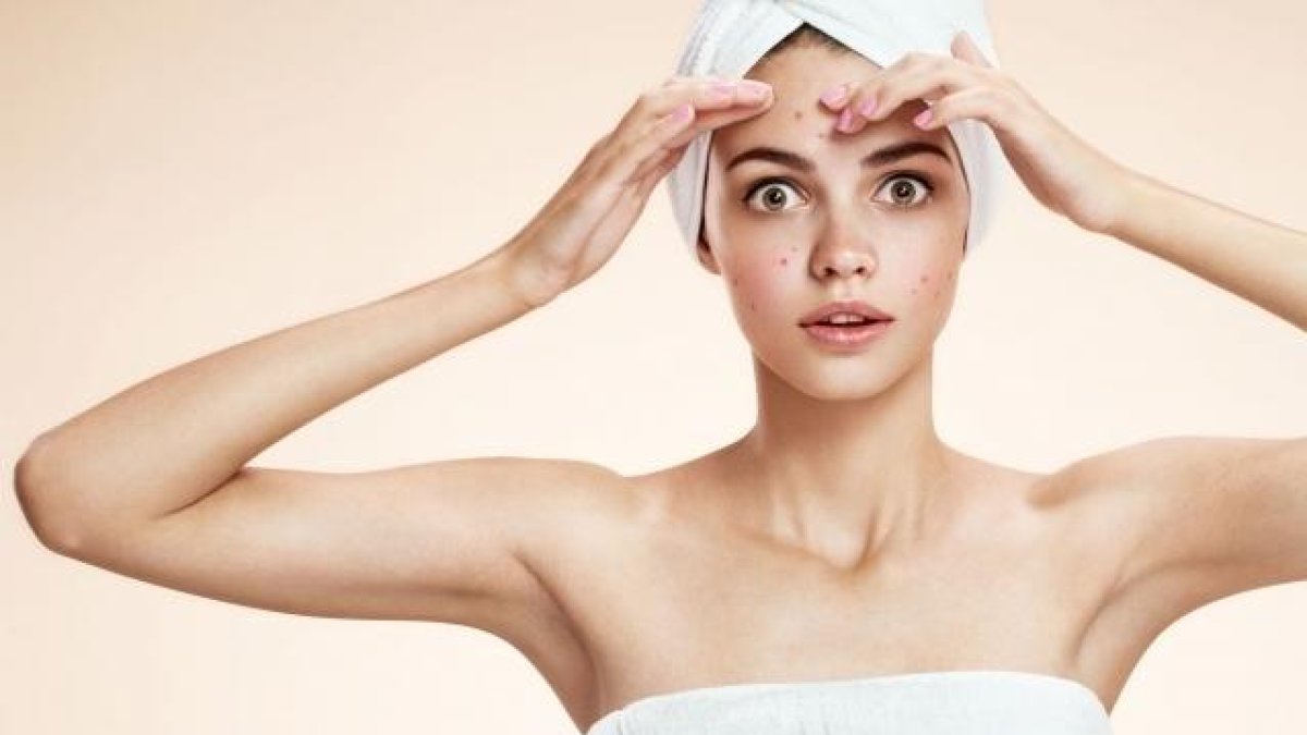 Consells per eliminar l'acne
