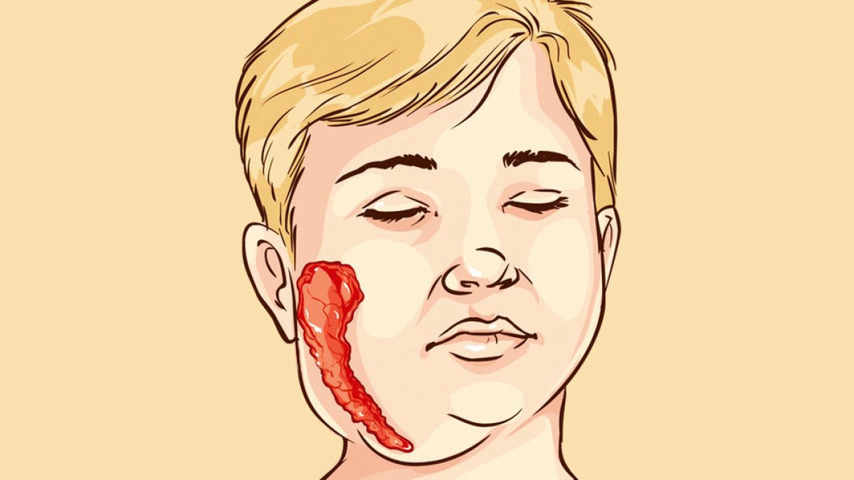 Govern proposa una nova dosi de triple vírica per la passa de galteres