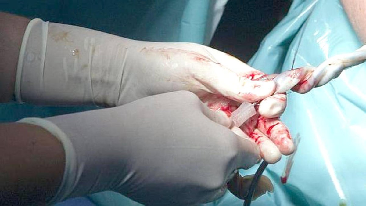 Tres trasplantaments amb les donacions de cordó umbilical