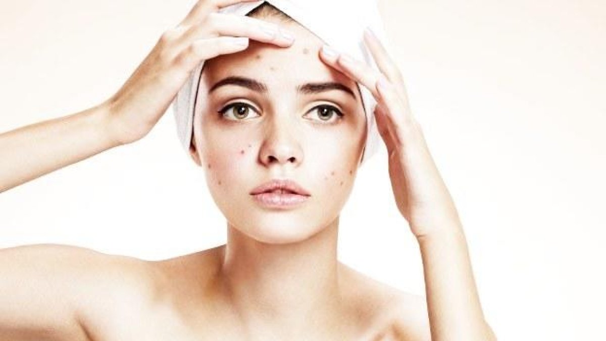 Anticonceptius per tractar l'acne