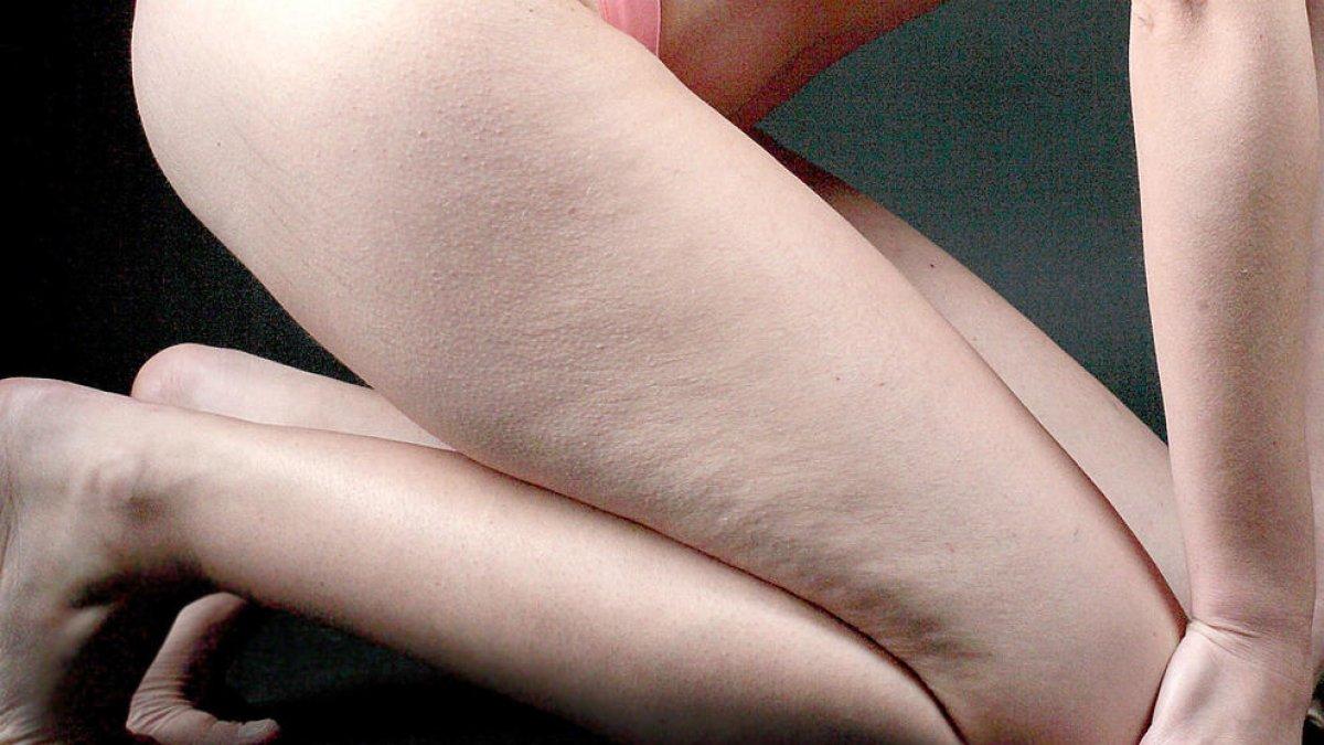 Tractar la cel·lulitis