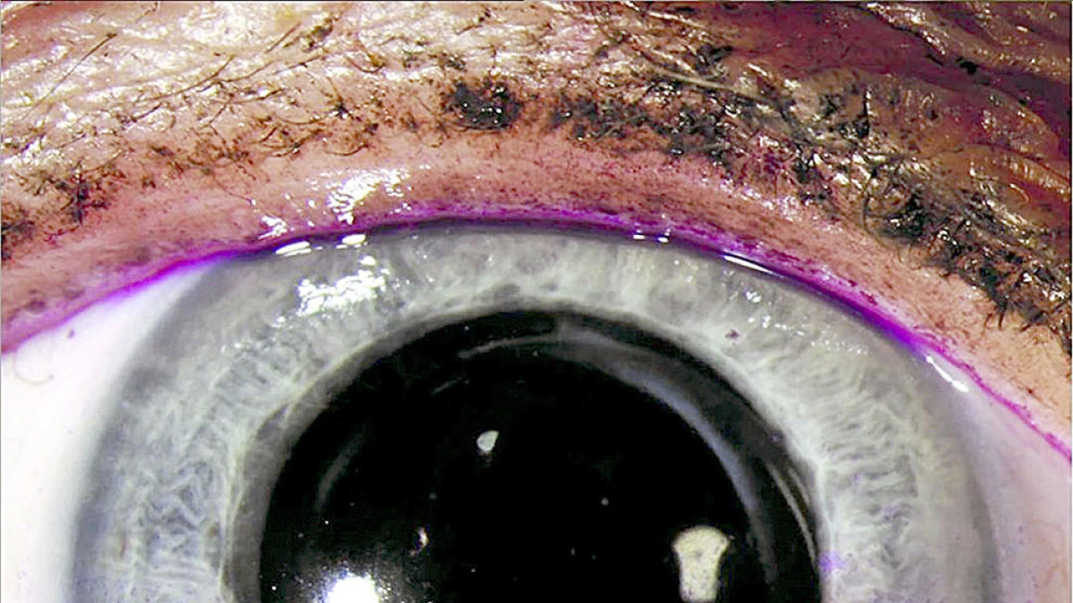 L'ús de la fluoresceïna