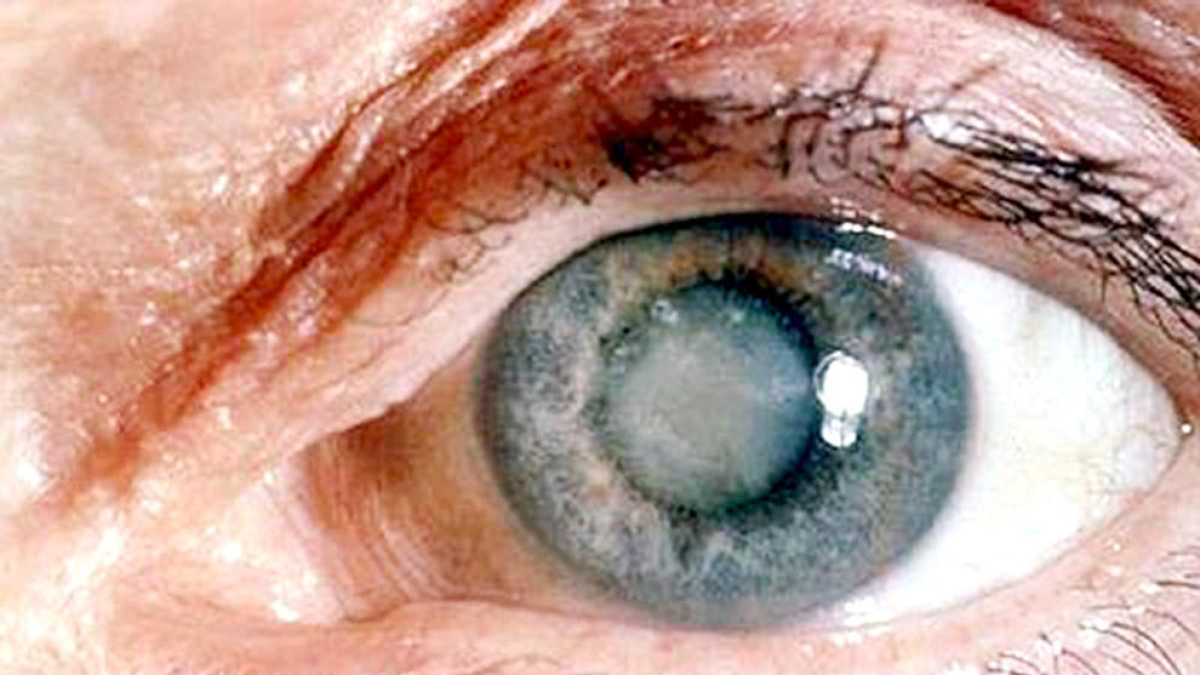 La cataracta secundària