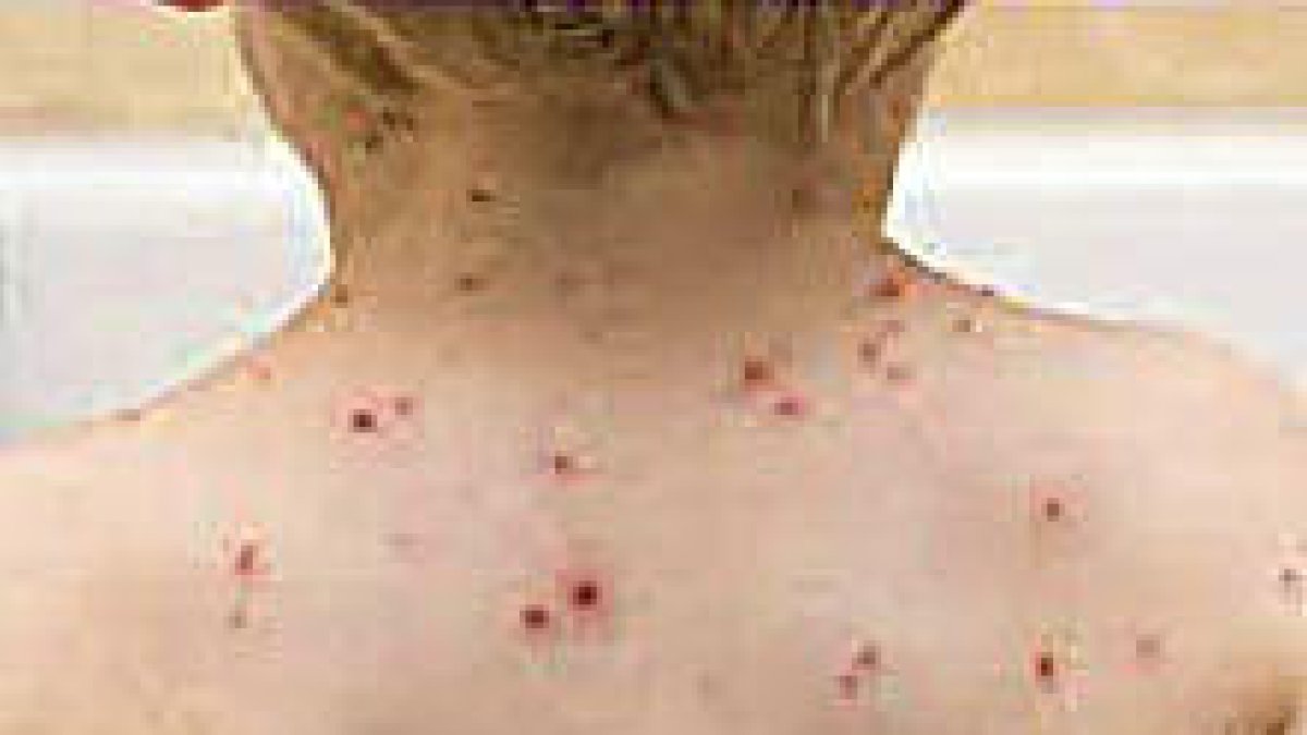 Efectes de la varicel·la.