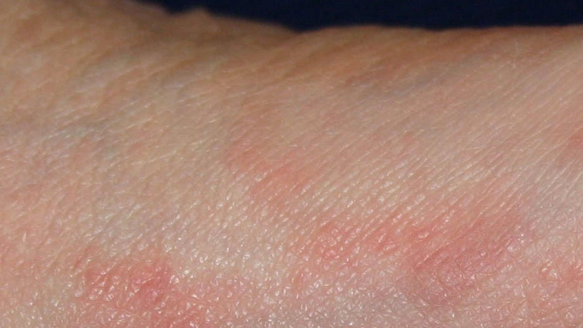 La sarna provoca grans i picor.