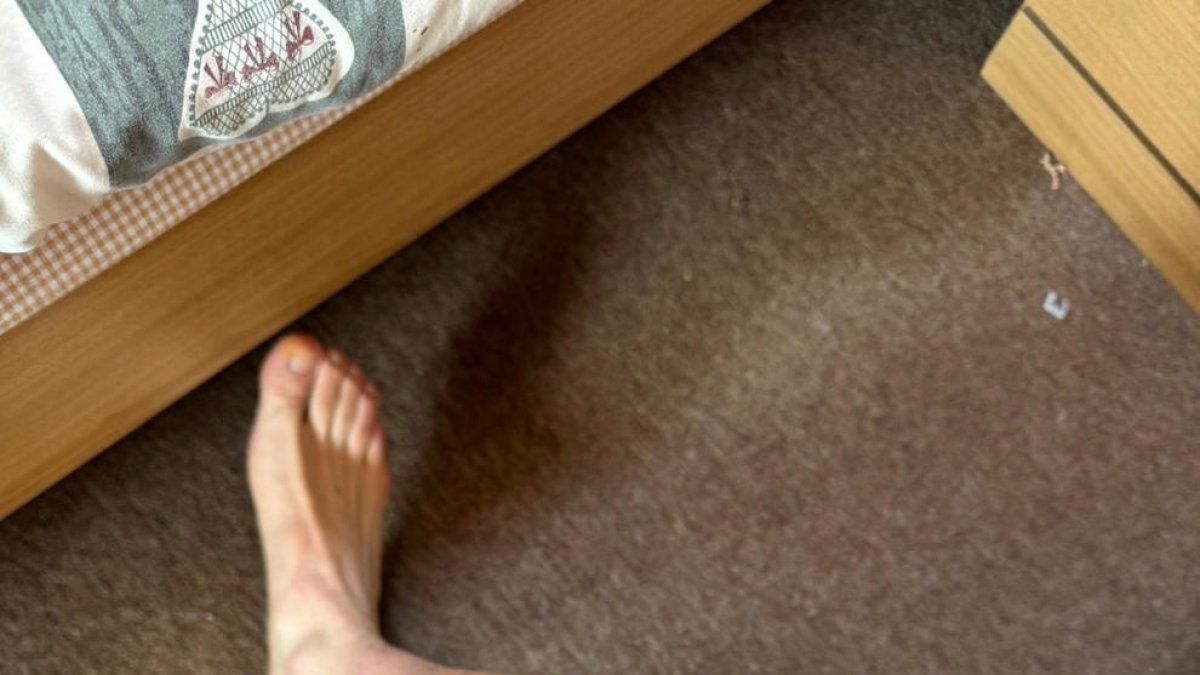 El genoll de Puig després de la caiguda.