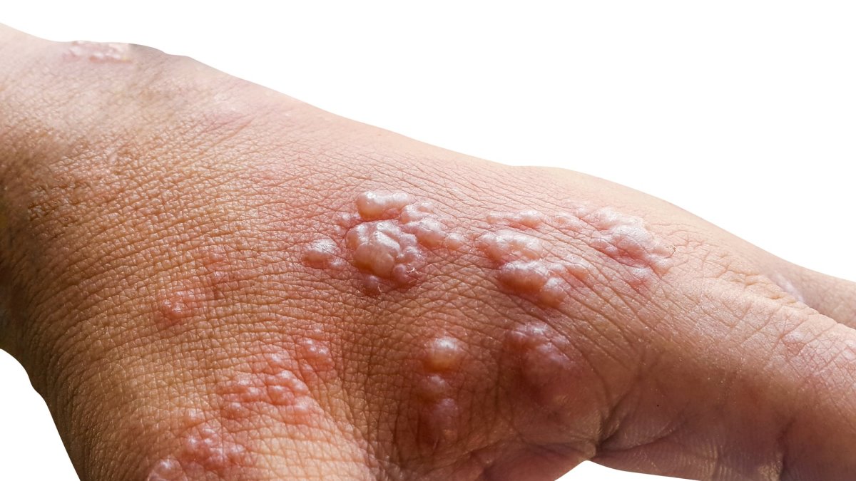 Erupció provocada per l’herpes zòster.