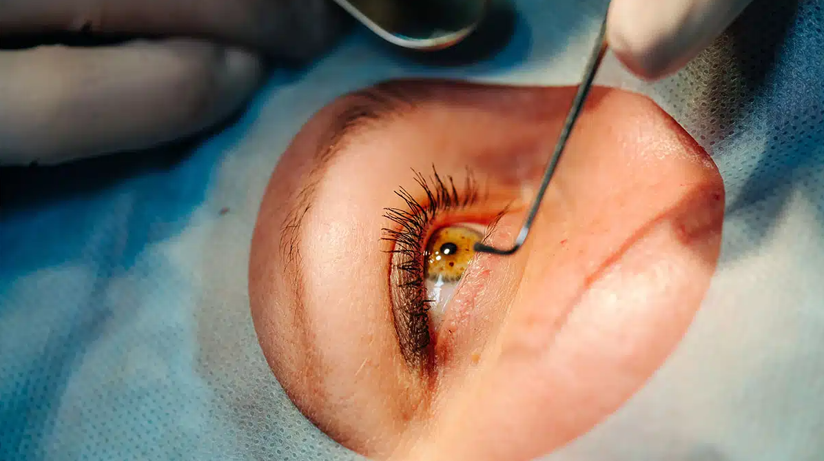 An operation on the cornea.